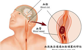 红葡萄酒可以有效预防中风后脑损伤