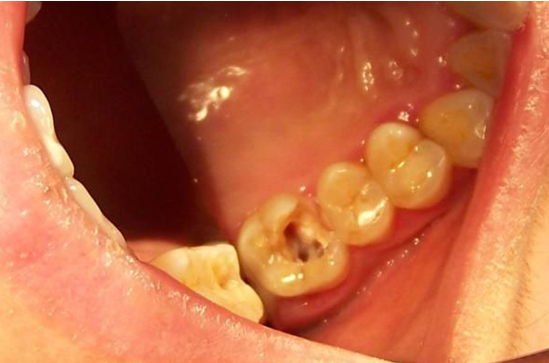 慢性牙髓炎怎么治?