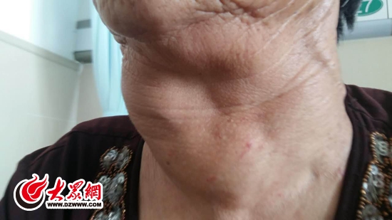 老人颈部长有直径20厘米肿瘤 东港区医院成功手术